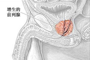 前列腺增生