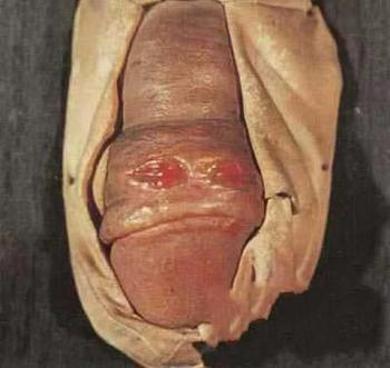 梅毒的危害有哪些