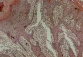 医生解读:湿疹的症状以及危害有哪些